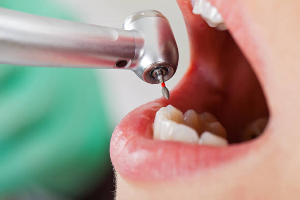 Best Emergency Root Canal Treatment in Sabetha, KS